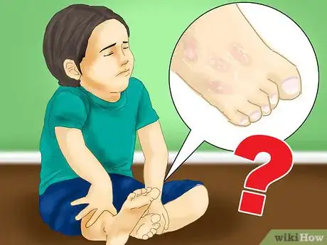 Image titled Recognize Hives (Urticaria) Step 7