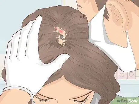 Image titled Bumps on Scalp Step 18