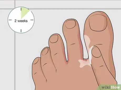 Image titled Get Rid of Foot Fungus at Home Step 03