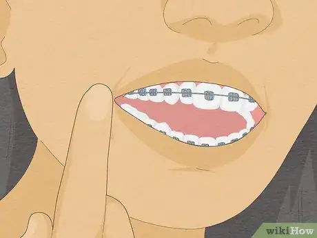 Image titled Temporarily Fix a Loose Wire on Your Braces Step 1