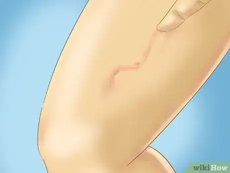 Image titled Recognize Hives (Urticaria) Step 5