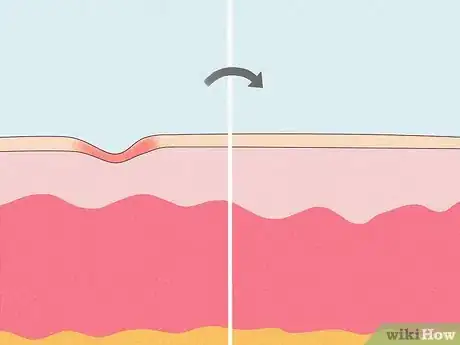 Image titled Treat Acne with Honey and Cinnamon Step 6