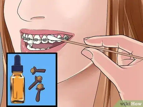 Image titled Survive the First Week in Braces Step 5