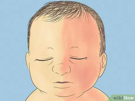 Image titled Know What to Expect on a Newborn's Skin Step 13