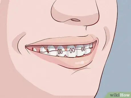 Image titled Smile when You Think You Have Bad Teeth Step 8