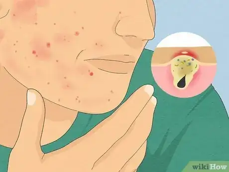 Image titled Tell if Acne Is Hormonal or Bacterial Step 2