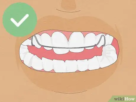 Image titled Fix Crooked Teeth Step 11