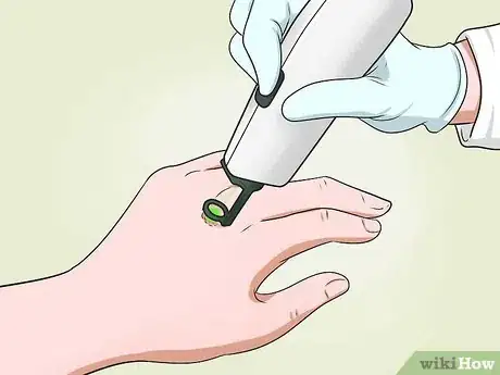 Image titled Get Rid of Warts on Hands Step 12