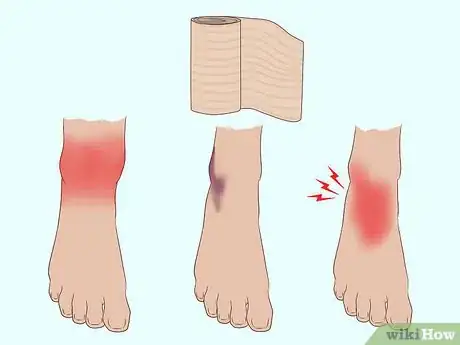 Image titled Wrap an Ankle with an ACE Bandage Step 10