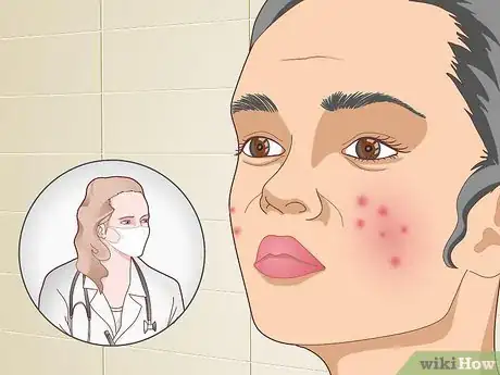 Image titled Prevent Acne Naturally Step 19