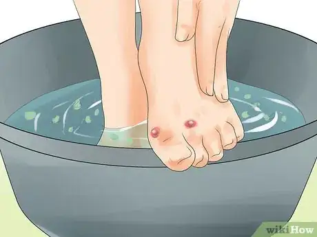 Image titled Make a Huge Blister Heal Step 14