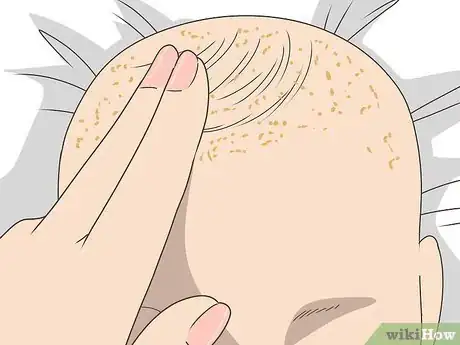 Image titled Get Rid of Cradle Cap Step 1