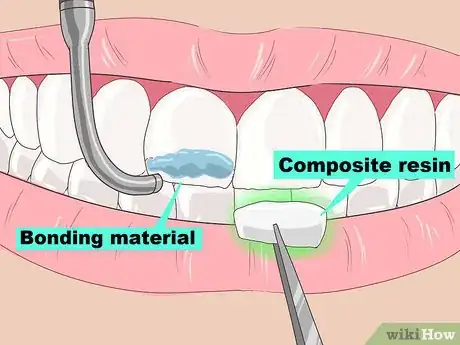 Image titled Remove Brown Stains from Teeth Step 8