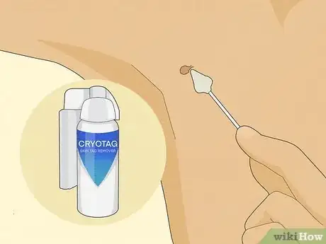 Image titled Get Rid of Skin Tags Step 11