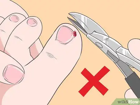 Image titled Fix Thick Toenails Step 4