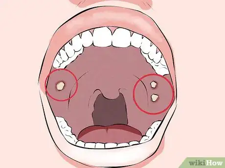 Image titled Recognize Signs of Oral Cancer Step 2