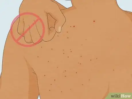 Image titled Treat Sand Flea Bites Step 6