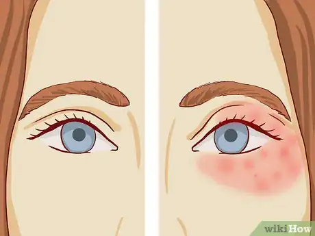 Image titled Treat Eczema Around the Eyes Step 3