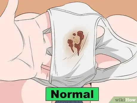 Image titled Tell if Vaginal Discharge Is Normal Step 5