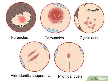 Image titled Stop Recurring Boils Step 2