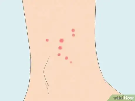 Image titled Identify Insect Bites Step 2