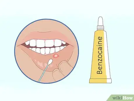 Image titled Get Rid of Mouth Blisters Step 10