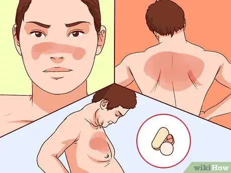 Image titled Diagnose Lupus Step 17