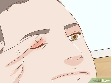 Image titled Heal a Swollen Eyelid Step 10