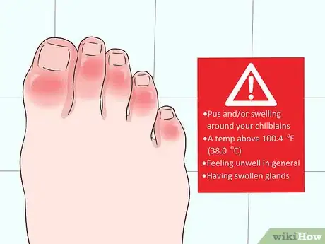 Image titled Get Rid of Chilblains Step 7