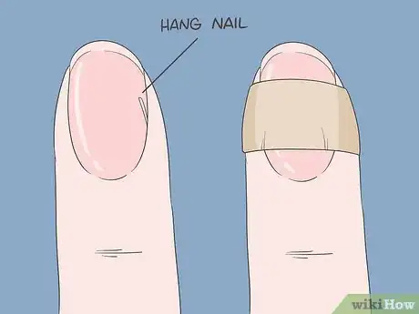 Image titled Heal Hangnails Fast Step 1