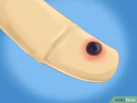 Image titled Pop a Blood Blister Step 1