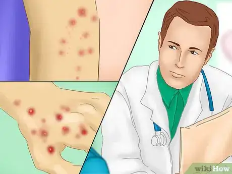 Image titled Avoid Catching Scabies Step 9