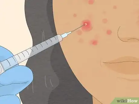 Image titled Get Rid of Cystic Acne Scars Step 20