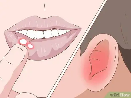 Image titled Fight Mouth Infection Step 13