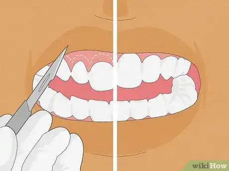 Image titled Straighten Your Teeth Without Braces Step 20