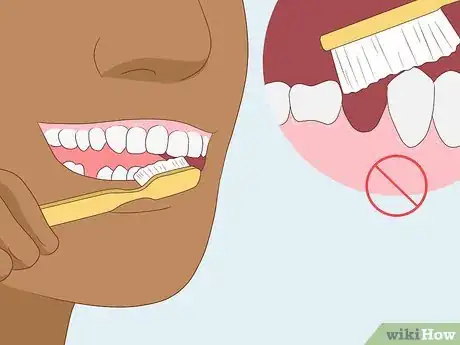 Image titled Prevent Dry Socket After a Tooth Extraction Step 4