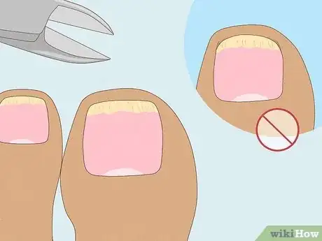 Image titled Trim Toenails with Fungus Step 5