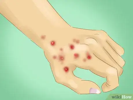 Image titled Avoid Catching Scabies Step 8