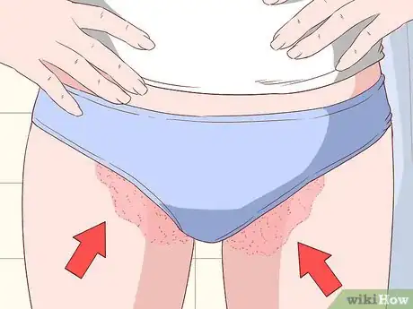 Image titled Know if You Have Jock Itch Step 1