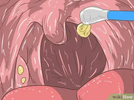 Image titled Remove Tonsil Stones (Tonsilloliths) Step 11