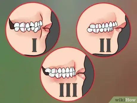 Image titled Diagnose an Overbite Step 3