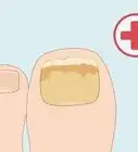 Cure Nail Fungus