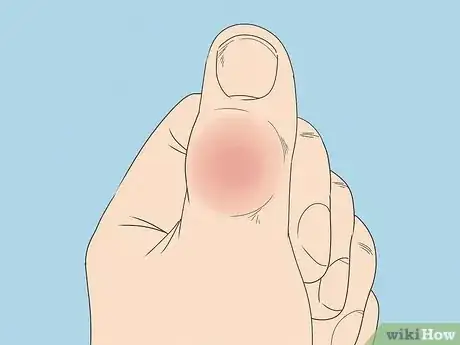 Image titled Diagnose a Broken Thumb Step 5