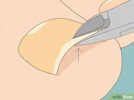 Image titled Remove a Dead Toenail Step 9