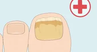 Cure Nail Fungus