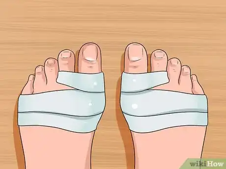 Image titled Get Rid of Bunions Step 6