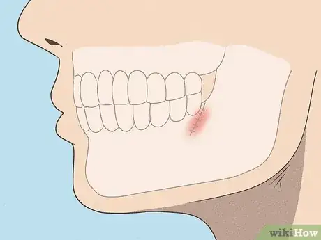 Image titled Stop Itchy Gums Step 5