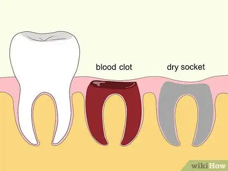 Image titled Relieve Dry Socket Step 1