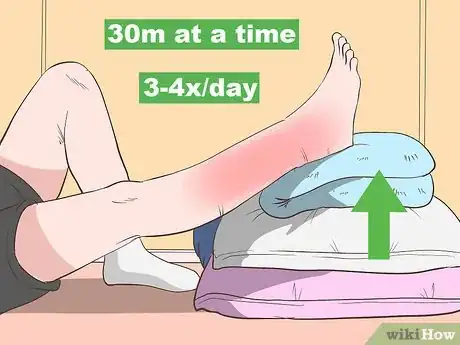 Image titled Reduce Leg Swelling Step 1