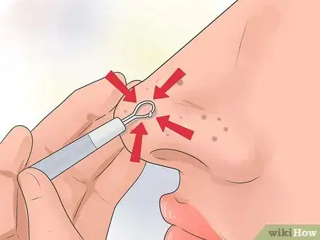 Image titled Remove Blackheads and Whiteheads with a Comedo Extractor Step 7